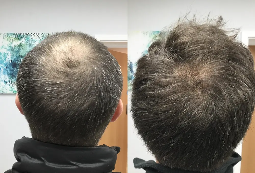 Antes y después