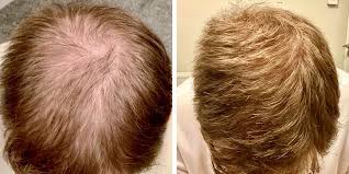 Antes y después