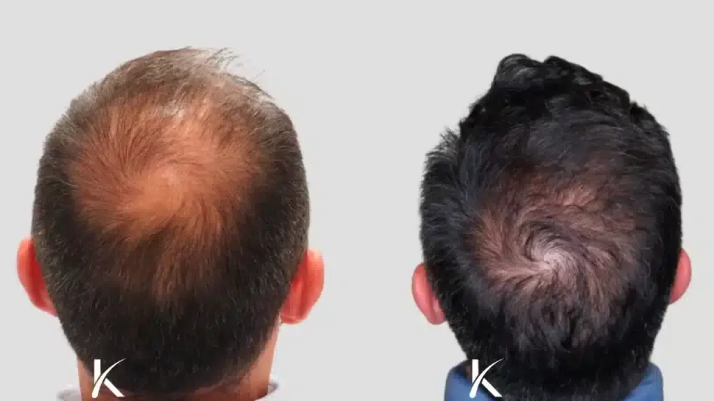 Antes y después